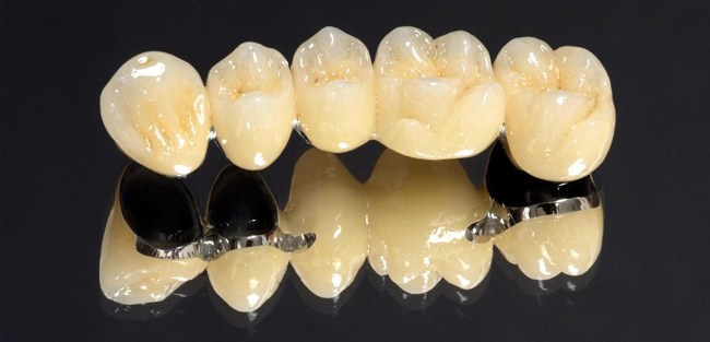 Metal Ceramics crown sodepur Agarpara dental clinic1