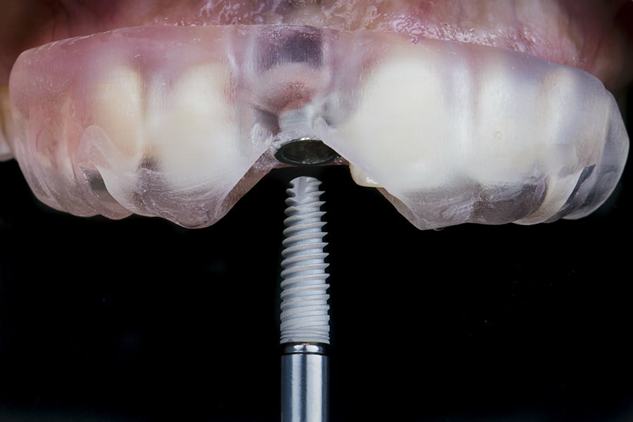 burbankdentallab dental implant workflows