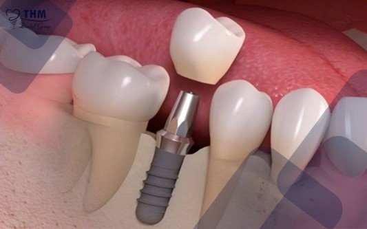 Các bước cấy ghép Implant - Lắp mão răng sứ