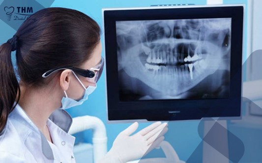 Các bước cấy ghép Implant - X-quang răng