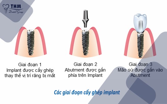 Quy trình cấy ghép Implant