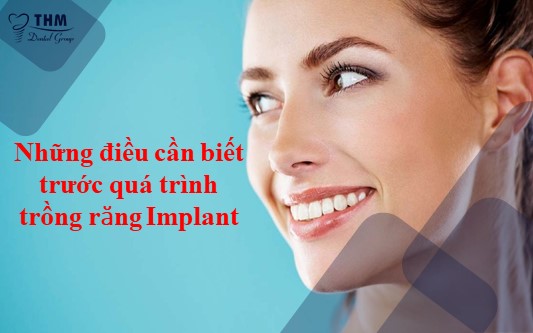 Trồng răng Implant và những điều cần biết