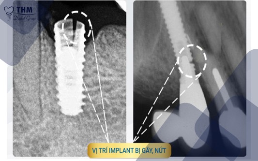 Biến chứng khi trồng răng Implant - gãy trụ Implant