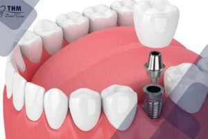 Phương pháp trồng răng Implant có phù hợp cho trẻ nhỏ?