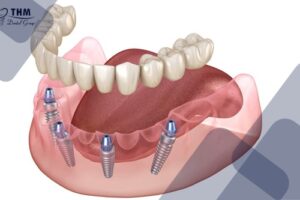 Bảng giá 105 Lợi ích thiết thực của quy trình cấy ghép All on 4