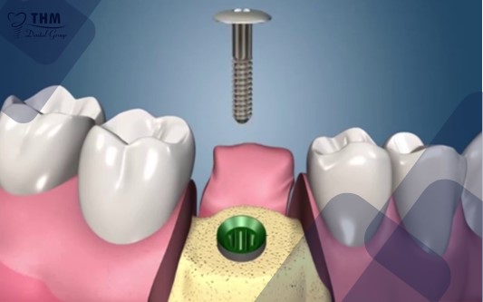 Quá trình diễn ra cấy ghép răng Implant All on 4