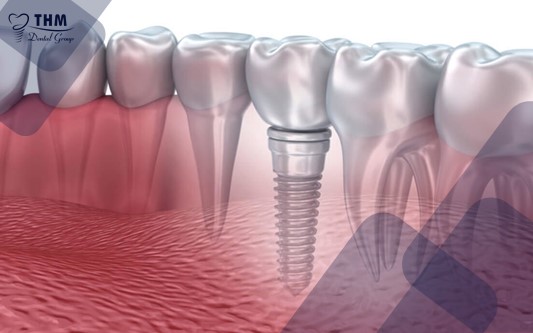 Những biến chứng thường gặp sau trồng răng Implant