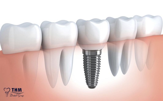 Bảng giá trồng răng Implant khá hợp lý