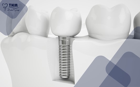 Các yếu tố ảnh hưởng đến tuổi thọ của răng Implant