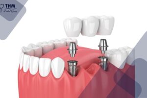 Bảng giá 114 Để câu hỏi trồng răng Implant giá bao nhiêu không còn là vấn đề lớn