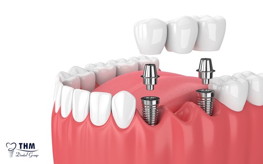 Để câu hỏi trồng răng Implant giá bao nhiêu không còn là vấn đề lớn