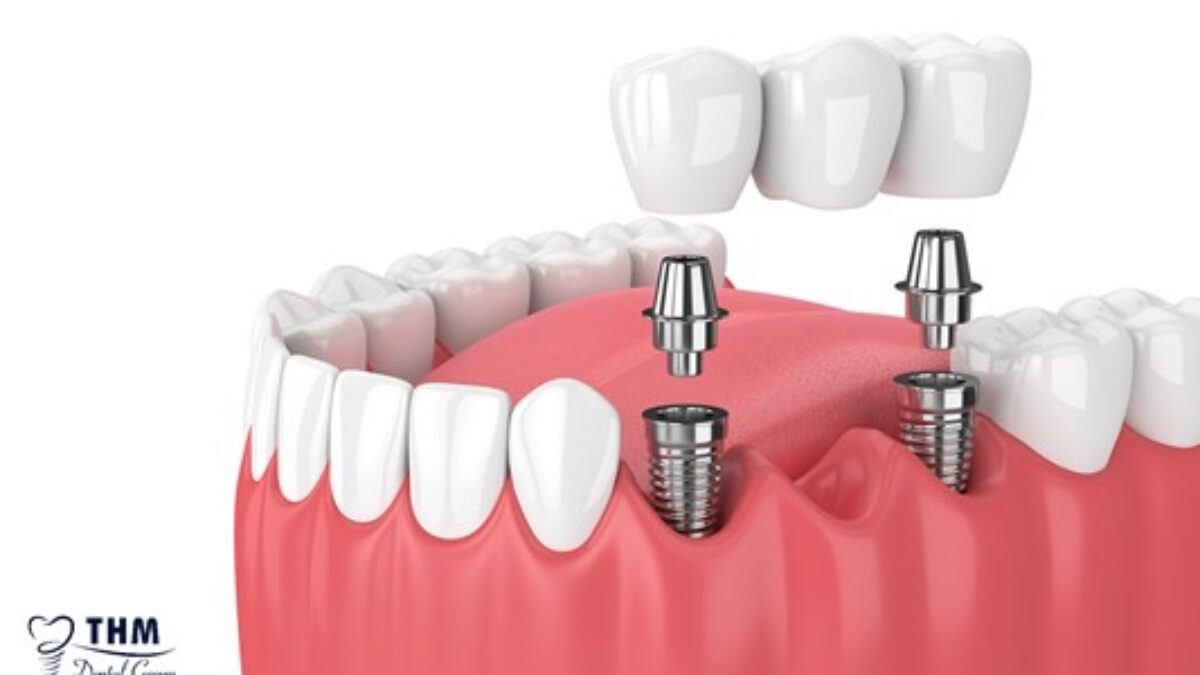 4. Ưu nhược điểm của răng giả implant