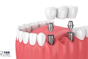 Bảng giá 115 Để câu hỏi trồng răng Implant giá bao nhiêu không còn là vấn đề lớn