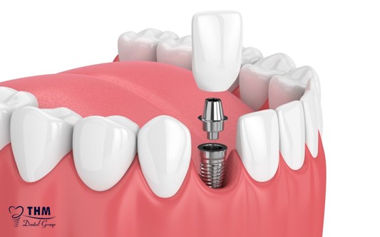 Định nghĩa về phương pháp ghép răng Implant All on 6