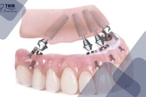 Bảng giá 104 Khái niệm về kỹ thuật cấy ghép Implant All on 4