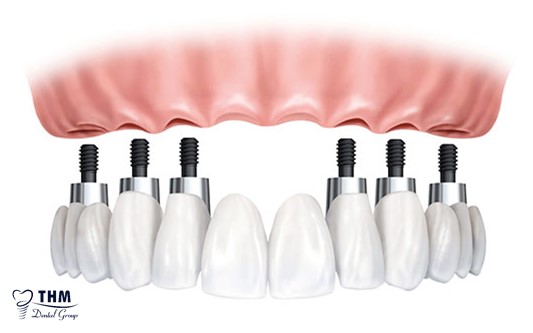 Kỹ thuật phục hình răng Implant All on 6 là gì?