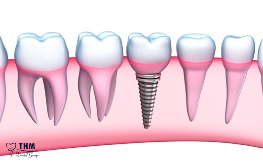 Những việc cần lưu ý sau khi trồng răng Implant đơn lẻ
