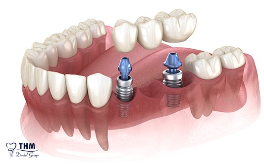 Phương pháp cấy ghép răng sứ trên nền trụ Implant