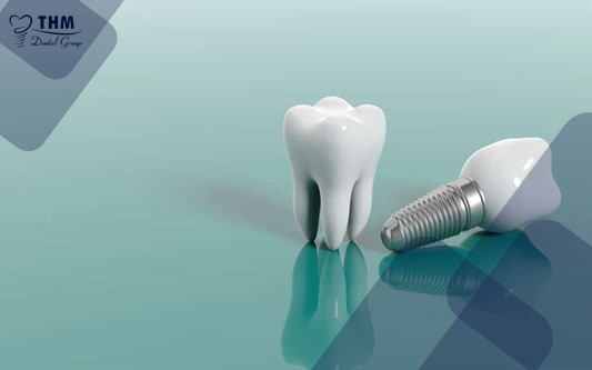 Quy trình cấy ghép răng Implant về ngay trong ngày