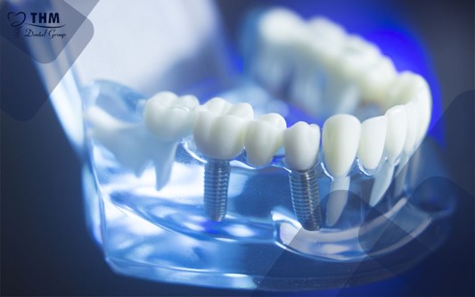 Thế nào là khung xương hàm đạt tiêu chuẩn trồng răng Implant?