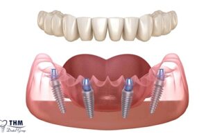 Bảng giá 103 Tổng quan về cấy răng Implant All on 4