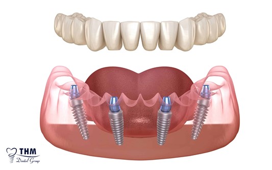Tổng quan về cấy răng Implant All on 4