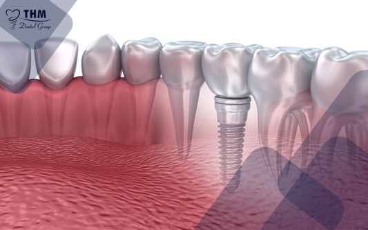 Ưu điểm của công nghệ làm răng Implant 4S