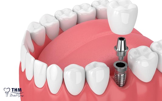 Ưu điểm của phương pháp cấy ghép răng Implant bắc cầu sứ