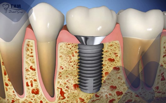 Ưu điểm về kỹ thuật nâng xoang trong làm răng Implant