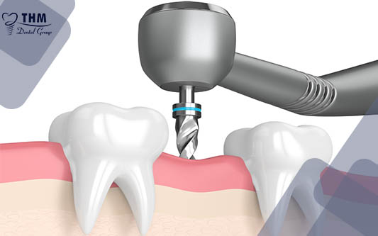 7 lời dặn sau khi cắm răng Implant mà bác sĩ muốn bạn thực hiện