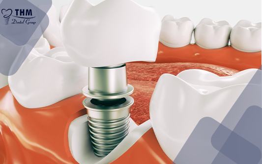Tư vấn bọc răng sứ và cấy ghép Implant