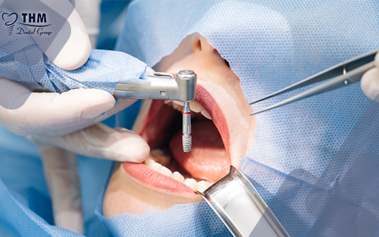 Tư vấn bọc răng sứ và cấy ghép Implant