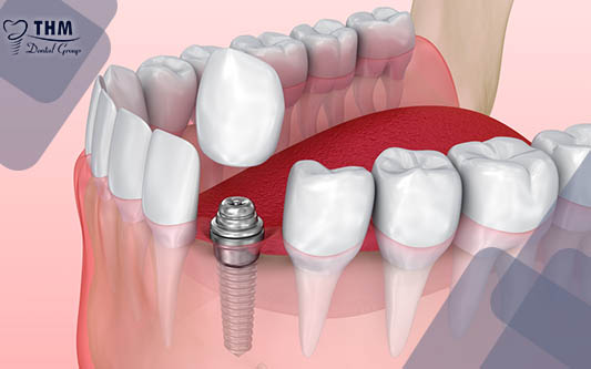 Cách né tránh biến chứng khi trồng răng Implant