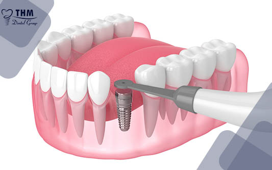 cắm răng Implant 15 phút siêu nhanh