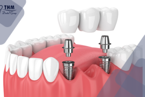 Bảng giá 113 Quy trình cầu răng sứ thẩm mỹ kết hợp Implant trong nha khoa
