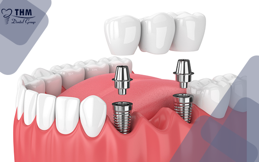 Quy trình cầu răng sứ thẩm mỹ kết hợp Implant trong nha khoa