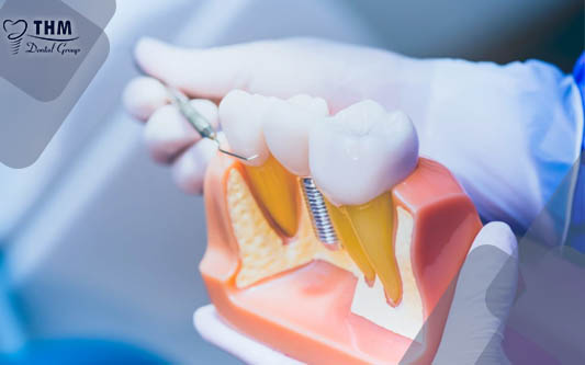 Có thể làm răng cấy ghép Implant nha khoa ngay sau nhổ chân răng không?
