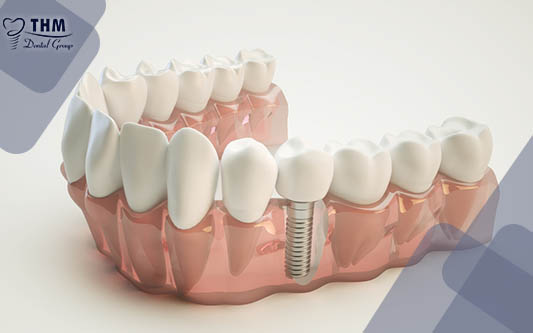 Có thể làm răng cấy ghép Implant nha khoa ngay sau nhổ chân răng không?