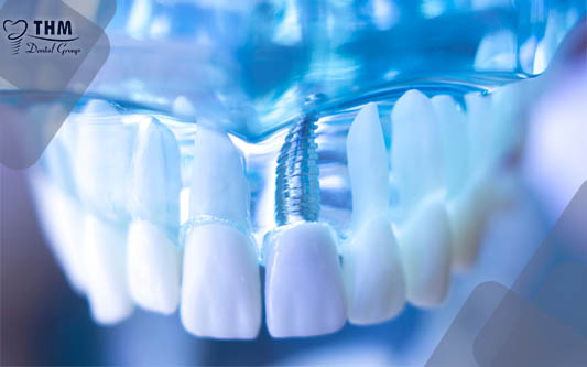 Số tiền để cấy Implant răng cửa là bao nhiêu, quá trình phẫu thuật sẽ ra sao?