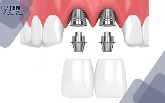 Số tiền để cấy Implant răng cửa là bao nhiêu, quá trình phẫu thuật sẽ ra sao?