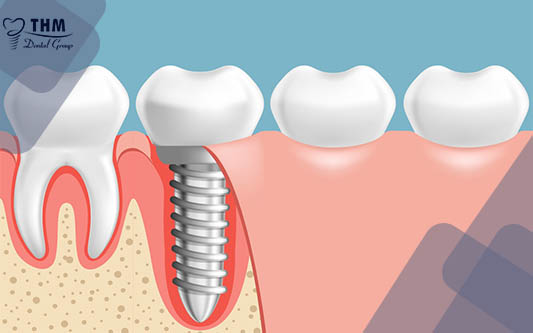 Implant nha khoa bảo tồn xương ổ răng trong nha khoa hiện đại