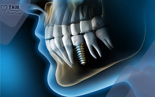 Implant nha khoa bảo tồn xương ổ răng trong nha khoa hiện đại