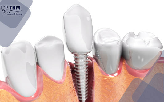 Làm sao để răng Implant kéo dài tuổi thọ mãi mãi?