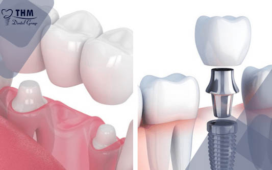 Nên chọn Cầu răng hay Cấy ghép Implant để trồng răng mới 2021