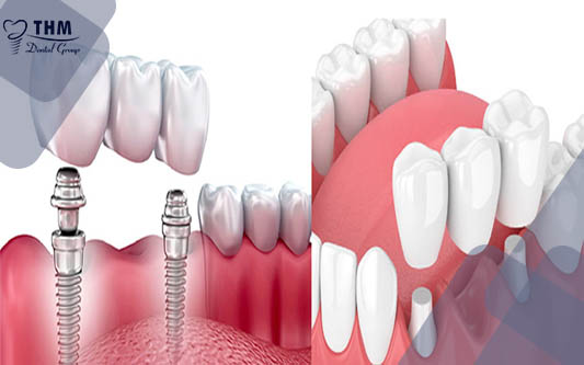 Nên chọn Cầu răng hay Cấy ghép Implant để trồng răng mới 2021