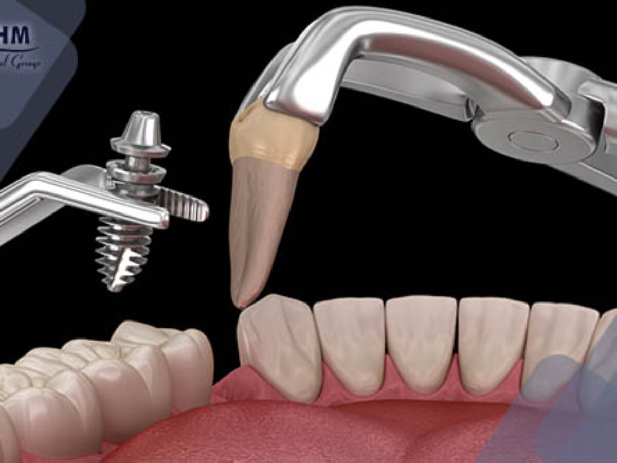 Sau Khi Nhổ Răng Bao Lâu Thì Trồng Implant? Thời Điểm Thích Hợp Và Quy Trình Chi Tiết