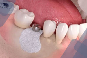 Bảng giá 108 Nguyên nhân nhổ răng ghép xương chuẩn bị trồng răng Implant