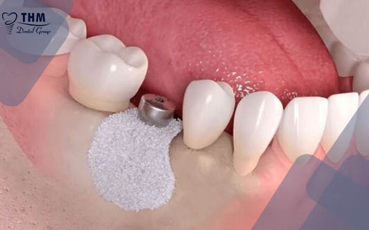 Nguyên nhân nhổ răng ghép xương chuẩn bị trồng răng Implant 