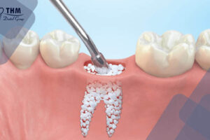 Bảng giá 107 Nguyên nhân nhổ răng ghép xương chuẩn bị trồng răng Implant