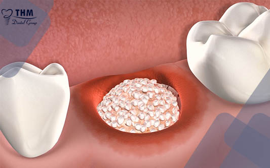 Nguyên nhân nhổ răng ghép xương chuẩn bị trồng răng Implant 
